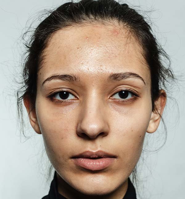 Before-facefour