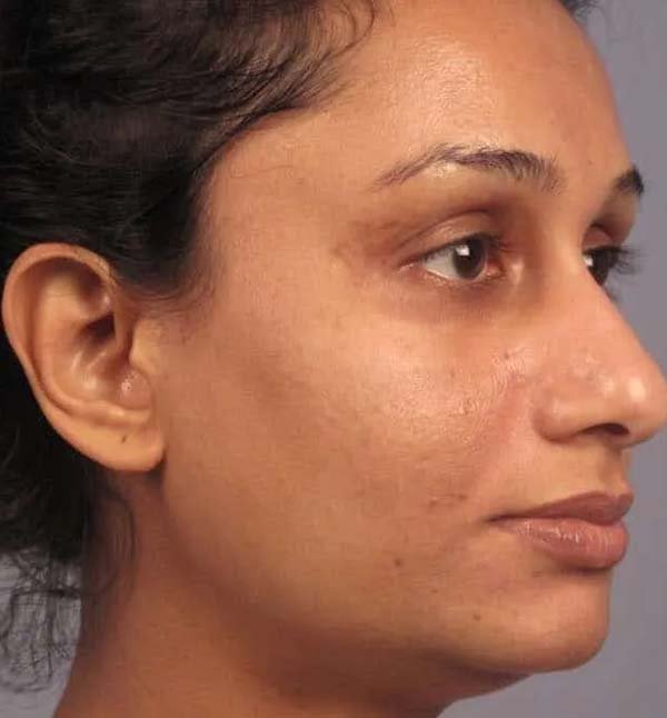 After-facefour