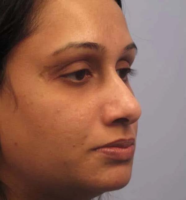 Before-facefour
