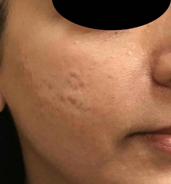 After-facefour