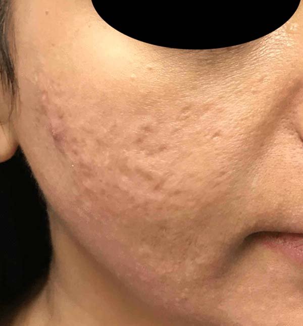 Before-facefour
